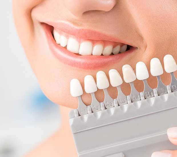 Norman Dental Veneers and Dental Laminates